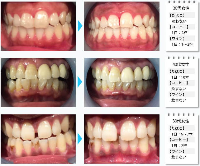 cooetfuu（クーエーフー）にてご利用いただけるセルフホワイトニング施術例