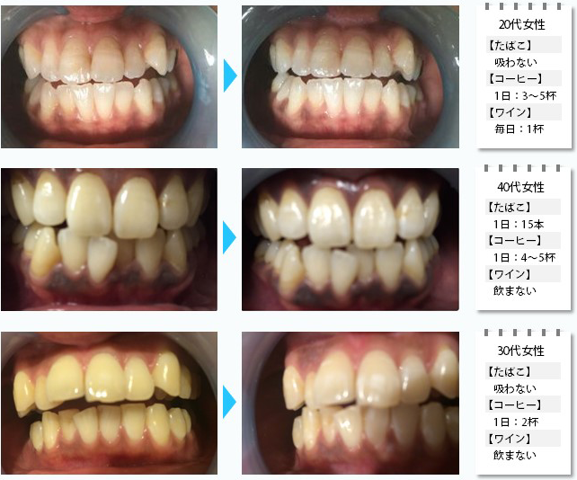 cooetfuu（クーエーフー）にてご利用いただけるセルフホワイトニング施術例