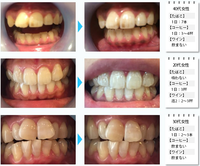 cooetfuu（クーエーフー）にてご利用いただけるセルフホワイトニング施術例